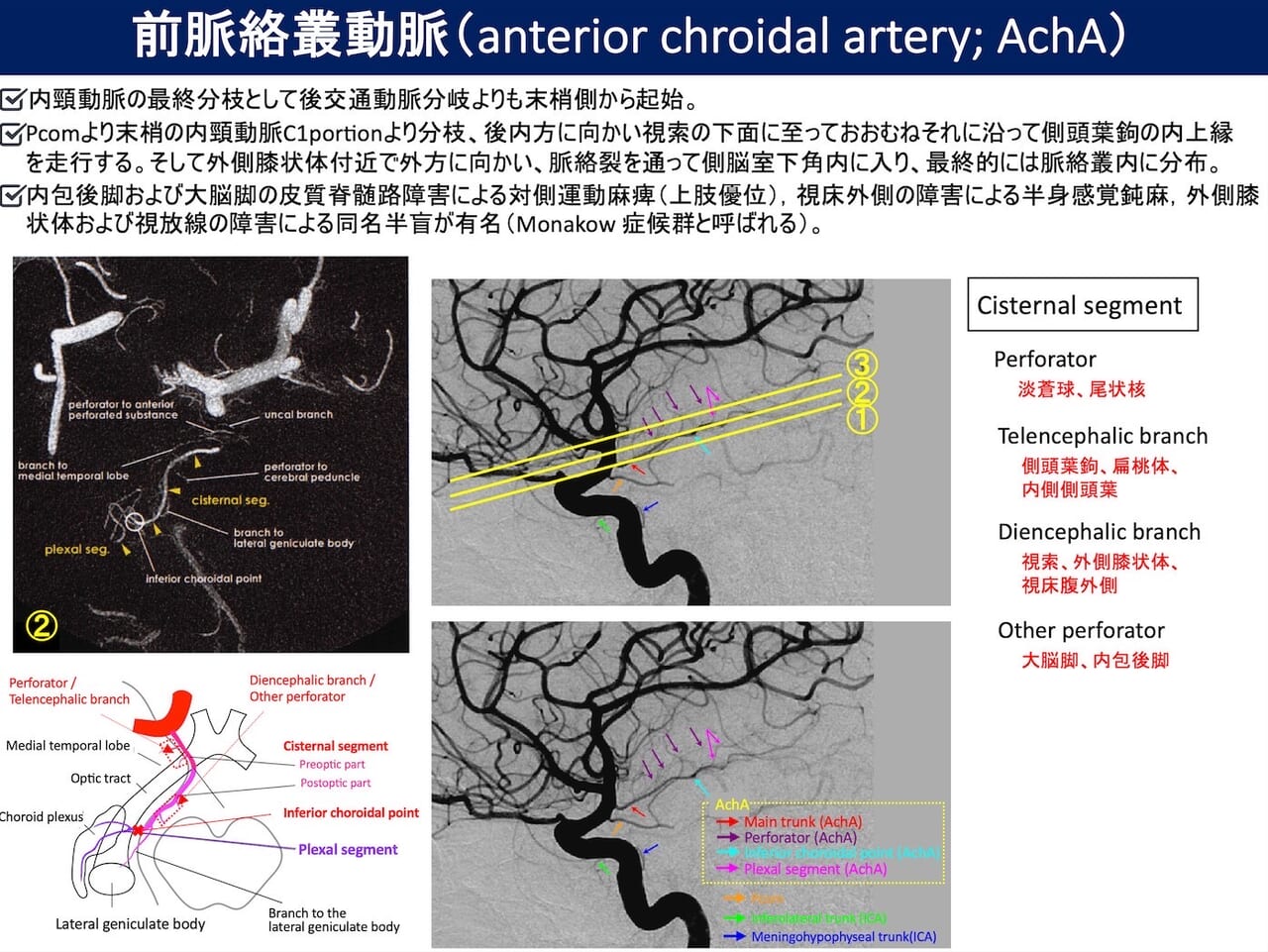 Medixpost | 前脈絡叢動脈（anterior chroidal artery; AchA