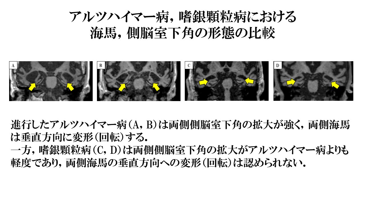 嗜 銀 顆粒 性 認知 症